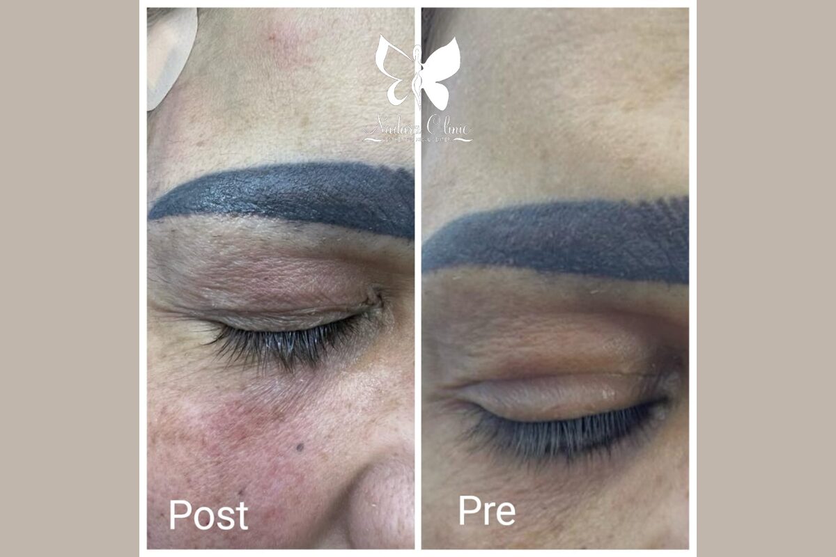 J-plasma in Hurghada